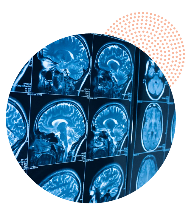 Uso de células madre en el tratamiento de condiciones neurológicas como Parkinson y Alzheimer
