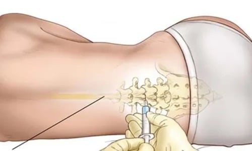 Administración de células madre en el canal espinal