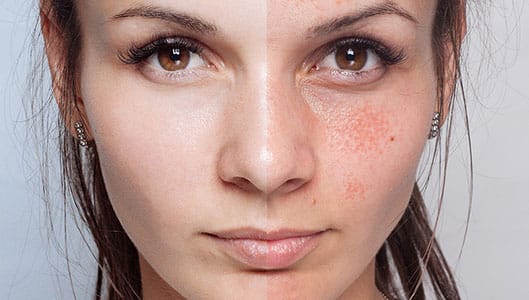 Terapia con células madre para afecciones dermatológicas