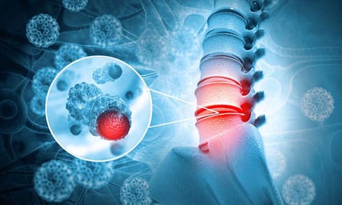 Extracción de células madre desde la médula ósea